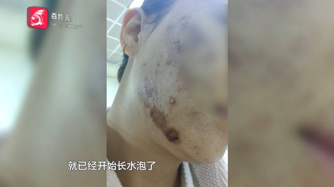 “顶着这张脸<strong></p>
<p>币币交易模式优势</strong>，我能去哪里”？贵阳一女子激光祛痘印疑被烫伤，感觉是烧糊了...