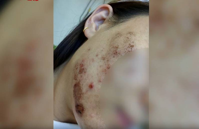 “顶着这张脸<strong></p>
<p>币币交易模式优势</strong>，我能去哪里”？贵阳一女子激光祛痘印疑被烫伤，感觉是烧糊了...