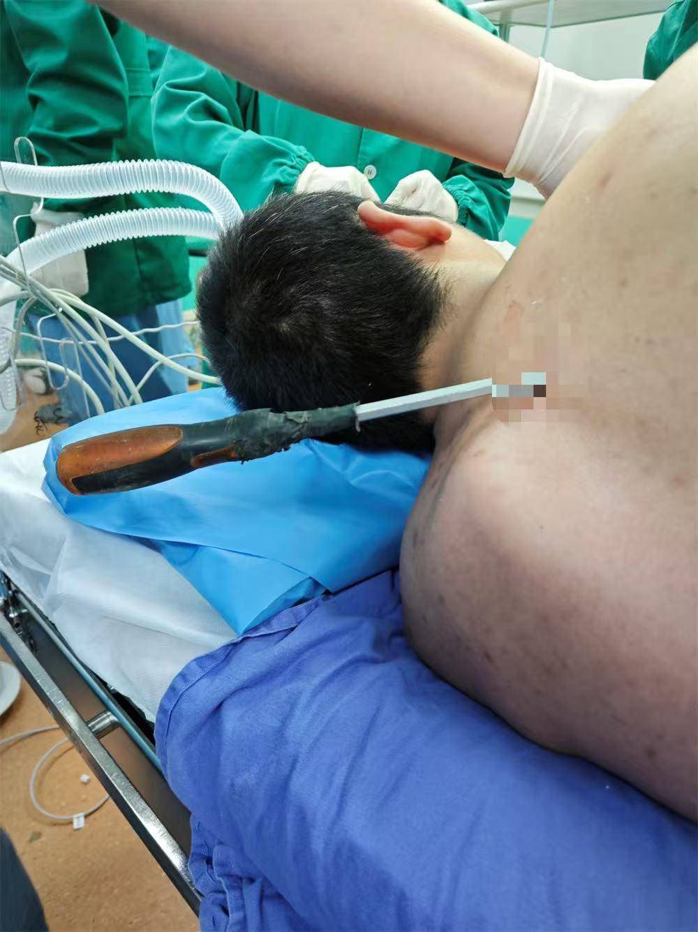 20米高空掉落螺丝刀直插男子胸腔<strong></p>
<p>币圈inchat</strong>！医生：不要自行拔除