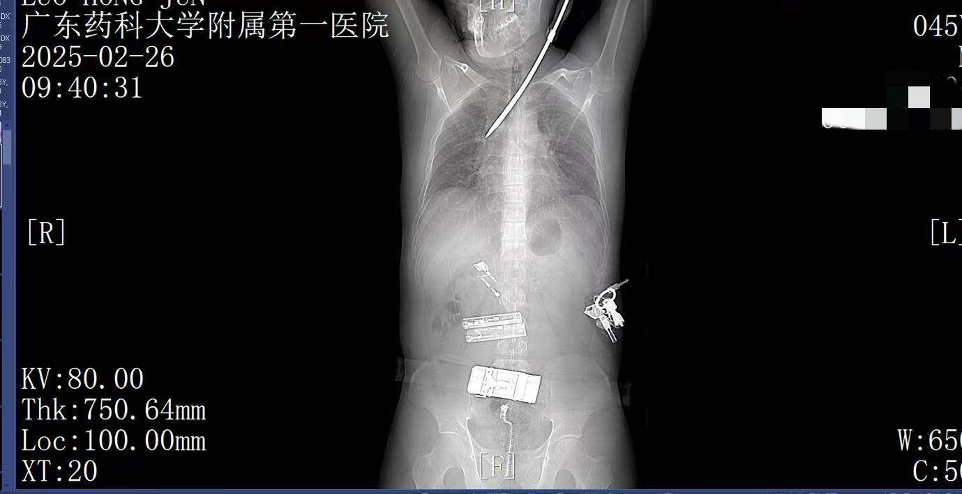 20米高空掉落螺丝刀直插男子胸腔<strong></p>
<p>币圈inchat</strong>！医生：不要自行拔除