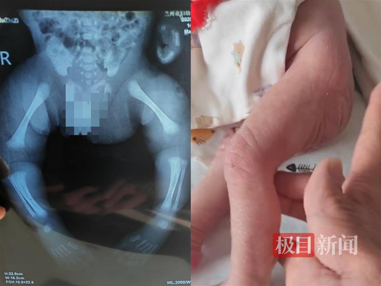 二胎出生查出先天性病症或落下残疾<strong></p>
<p>抖币怎么用</strong>，残疾父母称医院产检漏检、未尽告知义务，医院及医调委回应