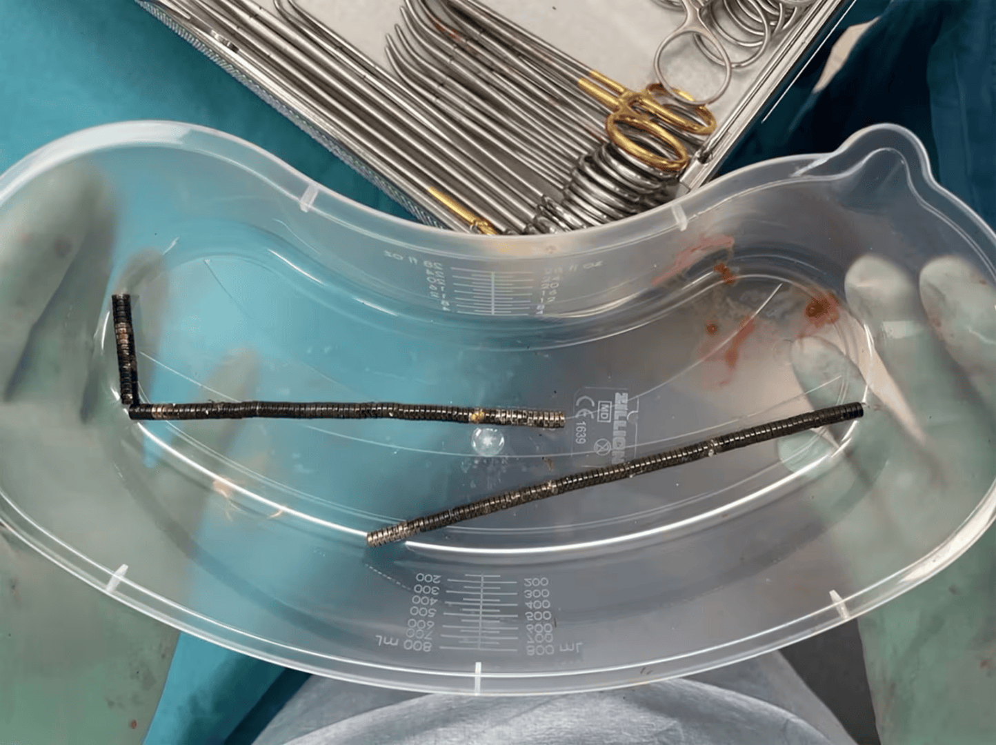 腹痛4天后送医<strong></p>
<p>以太坊app下载</strong>，新西兰男孩吞下约100颗磁铁致肠道坏死 医生切除部分肠组织